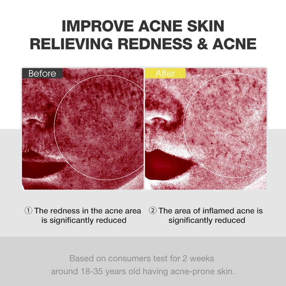 Overnight Acne Treatment Ice Sleep Masque